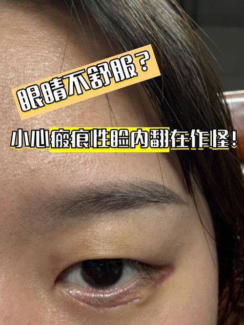 锡林郭勒盟矫正眼睑内翻哪家医院好？2026年锡林郭勒盟眼科医院选盟医院或蒙医医院眼科大夫更正规专业