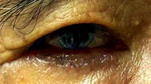 锡林郭勒盟矫正眼睑内翻医院选择总结