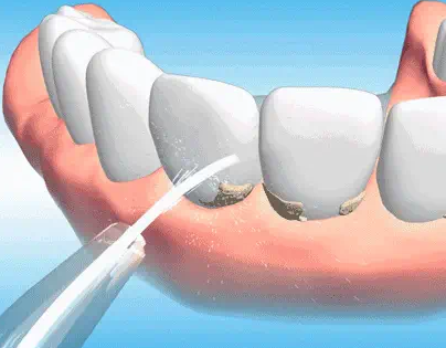 二、从这些典型症状，判断是否需要根管治疗