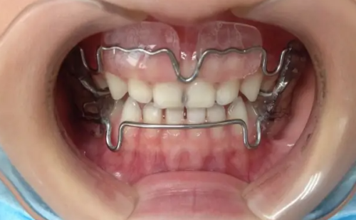 二、哪些情况需要做根管治疗