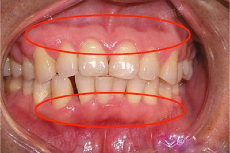 二、拔牙后吃火腿肠会引发感染吗？