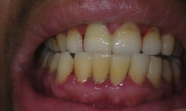 价格与性价比：美国植体溢价背后的价值