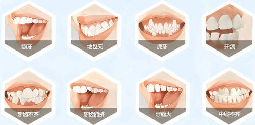 30副牙套实现快速排齐的核心逻辑