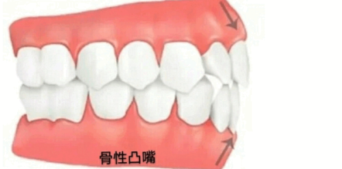 隐适美齿玥：为什么说它是好用的成人矫正选择