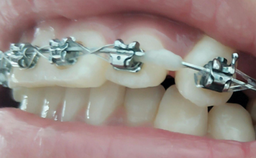 五、根管治疗后饮食“正确打开方式”：科学饮食护牙齿