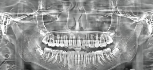 五、舌侧矫正（上舌下唇）的安装过程
