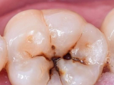 四、单颗活动义齿正确摘戴方法指南