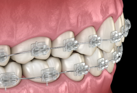 三、二次补牙的特殊操作要点