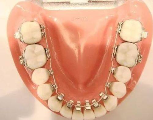 二、洗牙后牙缝变大的修复可能性分析