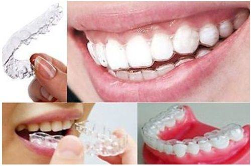 六、韩国奥齿泰种植牙适配人群与选择建议