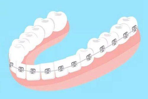 三、成年了地包天一定要手术吗?未必!