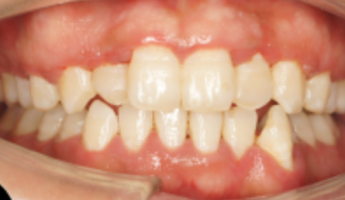 四、让根管治疗尽量不疼的实用方法