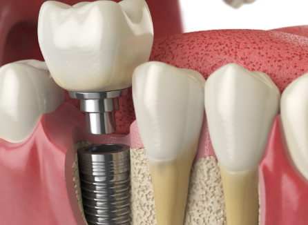 二、根管治疗到第几步就不疼了