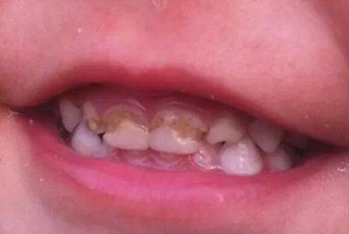 二、乳牙根管治疗后，恒牙还能正常萌出吗？