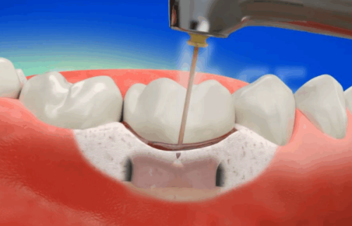五、6岁儿童补牙材质的实用选择指南