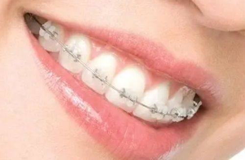 三、复合树脂：兼顾美观与耐用的灵活之选