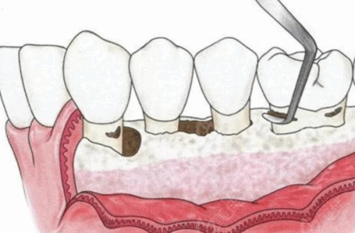 二、拔牙得干燥症是怎么回事——揪出背后的致病元凶
