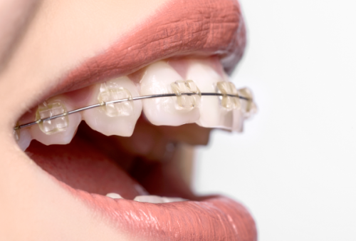 五、烤瓷牙人群坐飞机的出行准备指南