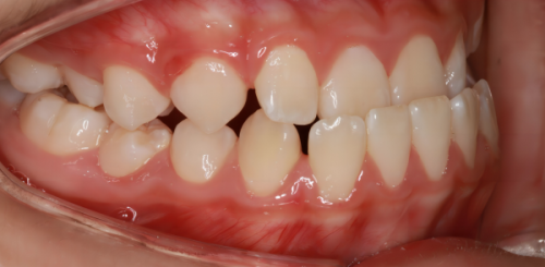 五、隐形活动义齿使用成效怎么样?