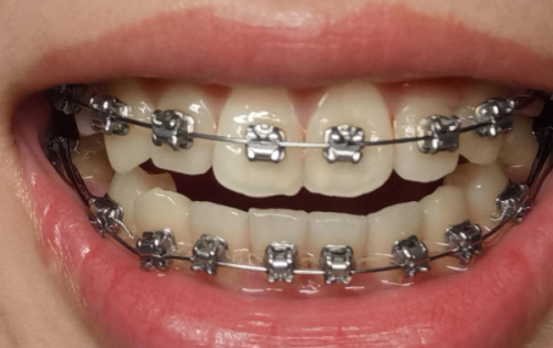 二、哪些情况可以保留天然牙根做种植牙