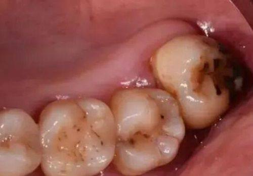 三、不同类型地包天的重度程度对应关系