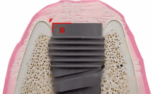 适应1-2个月后：媲美天然牙的日常体验