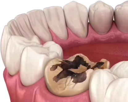 四、廊坊济民口腔补牙全流程提示