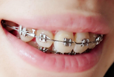 五、拔牙完吃羊肉的正确打开方式