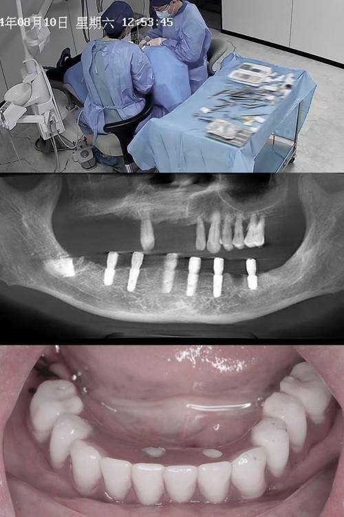 昆明市口腔医院口腔种植科口碑评价