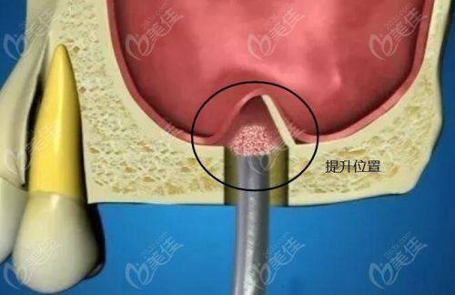 昆明市口腔医院口腔种植科医生名单及擅长领域：
