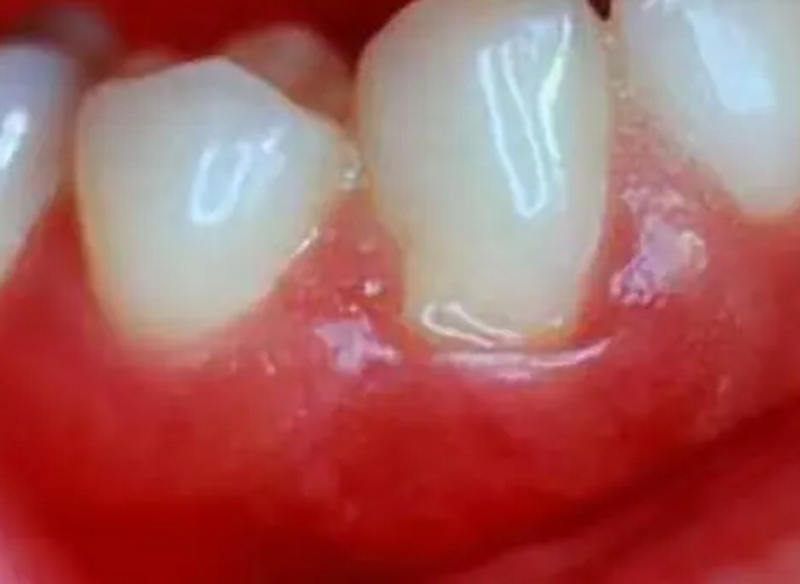 二、居家牙齿美白：安心温和的日常护理法