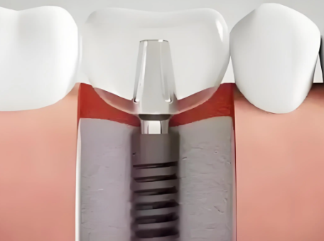二、空腹血糖9.2可以拔牙吗