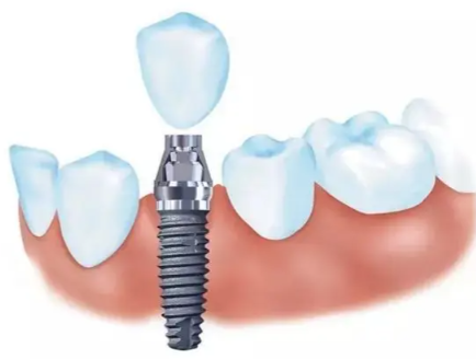 六、烤瓷牙崩瓷的后续注意事项