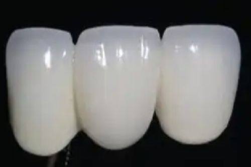 二、烤瓷牙与全瓷牙各自优劣势拆解