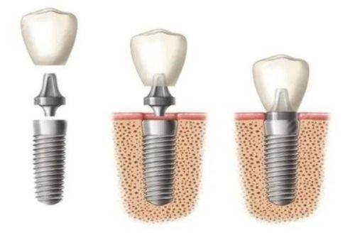 四、第二次根管治疗的时长说明