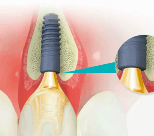 四、特殊人群专属选择指南