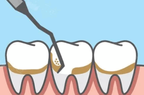 五、乳牙根管一般多长，长度差异受哪些因素影响