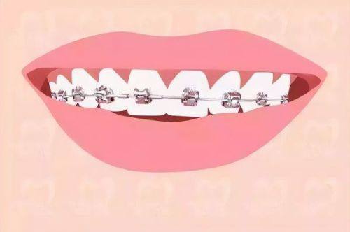 二、判断普通牙是否补牙的关键参考因素