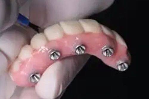 三、不及时补普通牙的重度后果