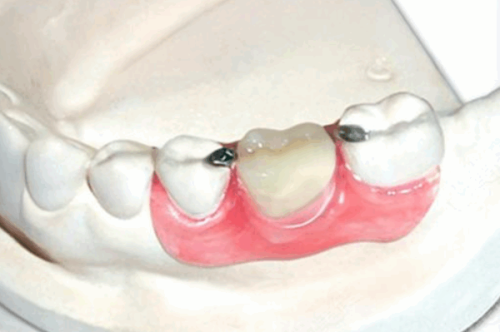 五、选购全瓷牙冠的关键注意事项