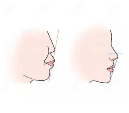 三、儿童根管治疗：小剂量麻药守护无疼体验