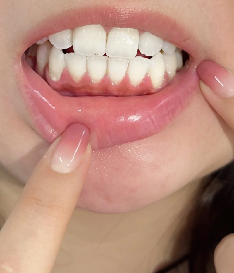 四、成人龅牙矫正费用解析