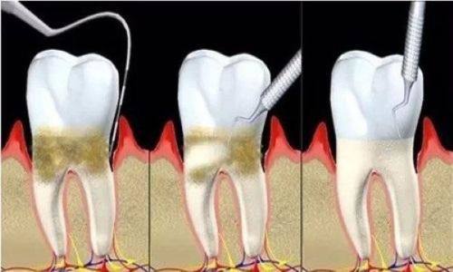 三、含金属烤瓷牙:风险需根据情况细分评估