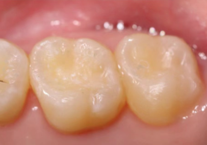 二、全瓷烤瓷牙:做核磁共振几乎无风险