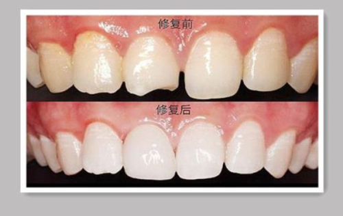 四、咬合关系异常：拔牙优化咬合功能，维护口腔健康
