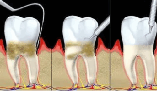 五、根管治疗第一次后的后续安排