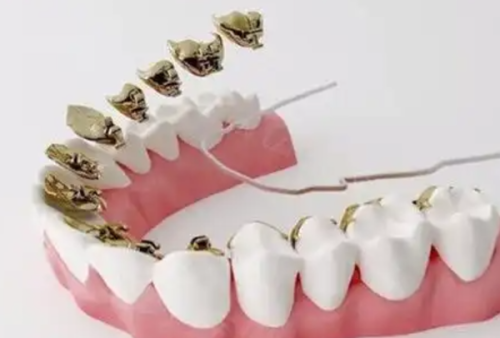 三、追求侧貌美观：拔牙助力打造柔和协调的面部线条