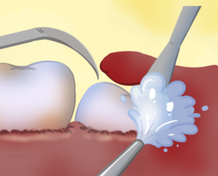 五、特定错颌畸形类型：拔牙为复杂矫正创造必要空间