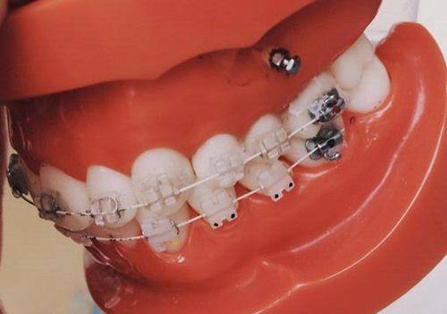 二、22岁牙性/轻度骨性地包天：正畸矫正的靠谱选项与真实实例