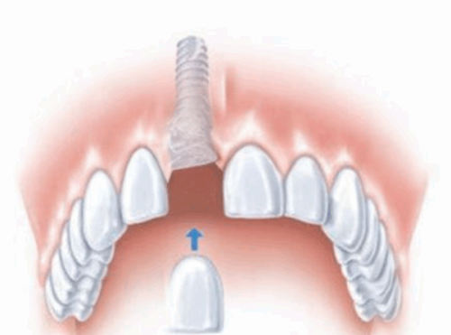 四、22岁地包天矫正的核心注意事项